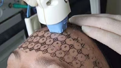 三种额纹去除方法公示,第3种适应症最广 三种额纹去除方法公示,第3种适应症最广