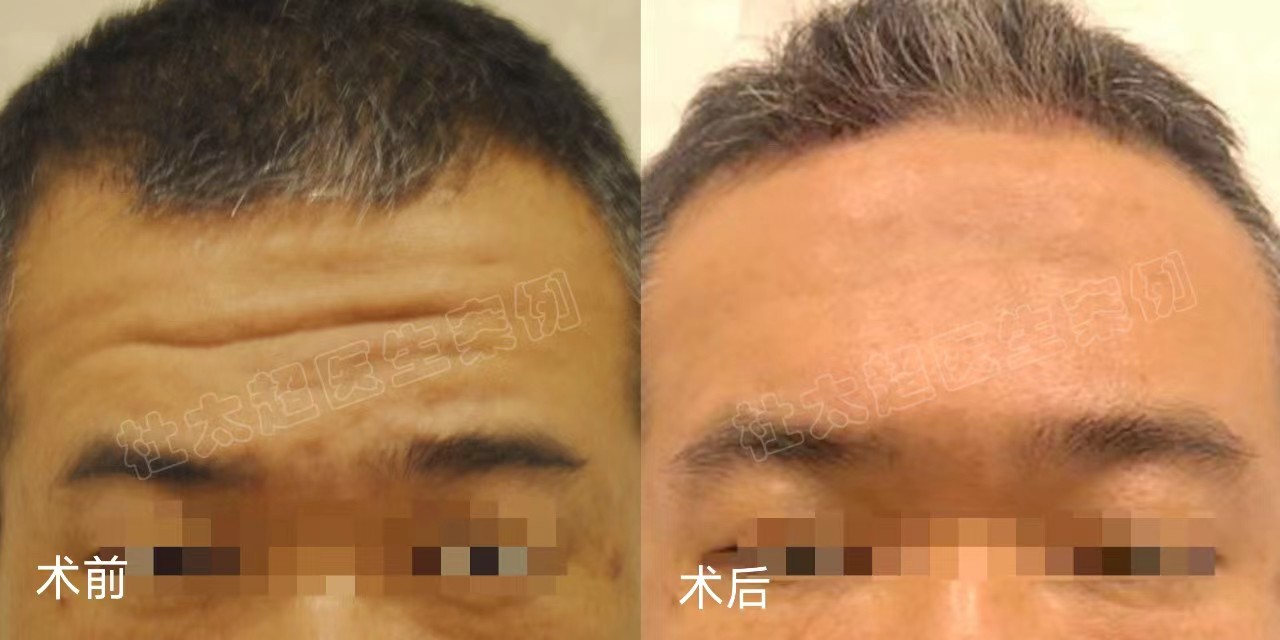 三种额纹去除方法公示,第3种适应症最广 三种额纹去除方法公示,第3种适应症最广