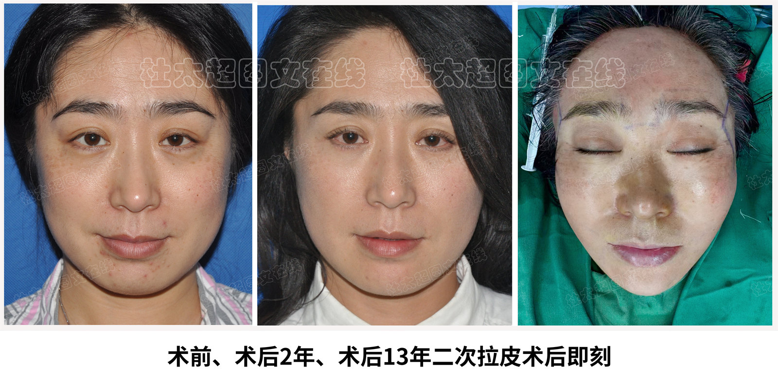 术前、术后2年、术后13年二次拉皮术后即刻