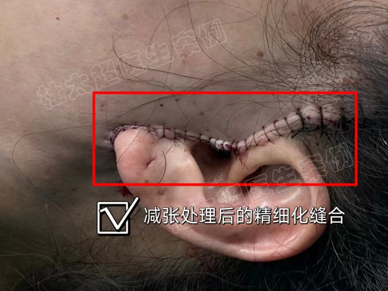 脸部拉皮有没有后遗症?这3点你需要知道 脸部拉皮有没有后遗症?这3点你需要知道