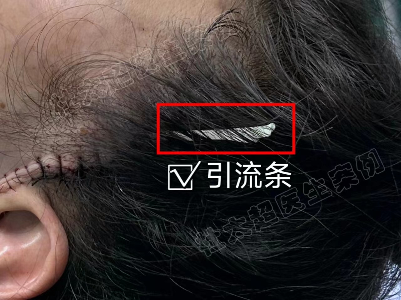 脸部拉皮有没有后遗症?这3点你需要知道 脸部拉皮有没有后遗症?这3点你需要知道