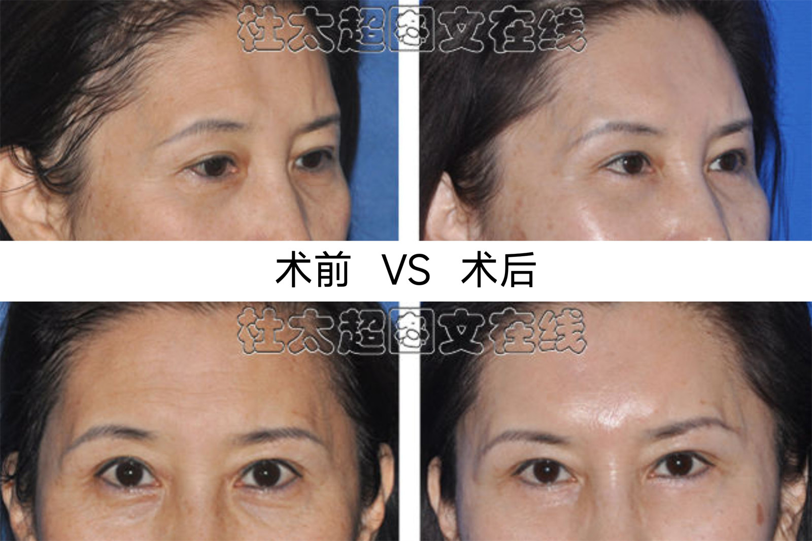 63岁做二次拉皮,活成令人羡慕的小女人,分享2点经验 63岁做二次拉皮,活成令人羡慕的小女人,分享2点经验