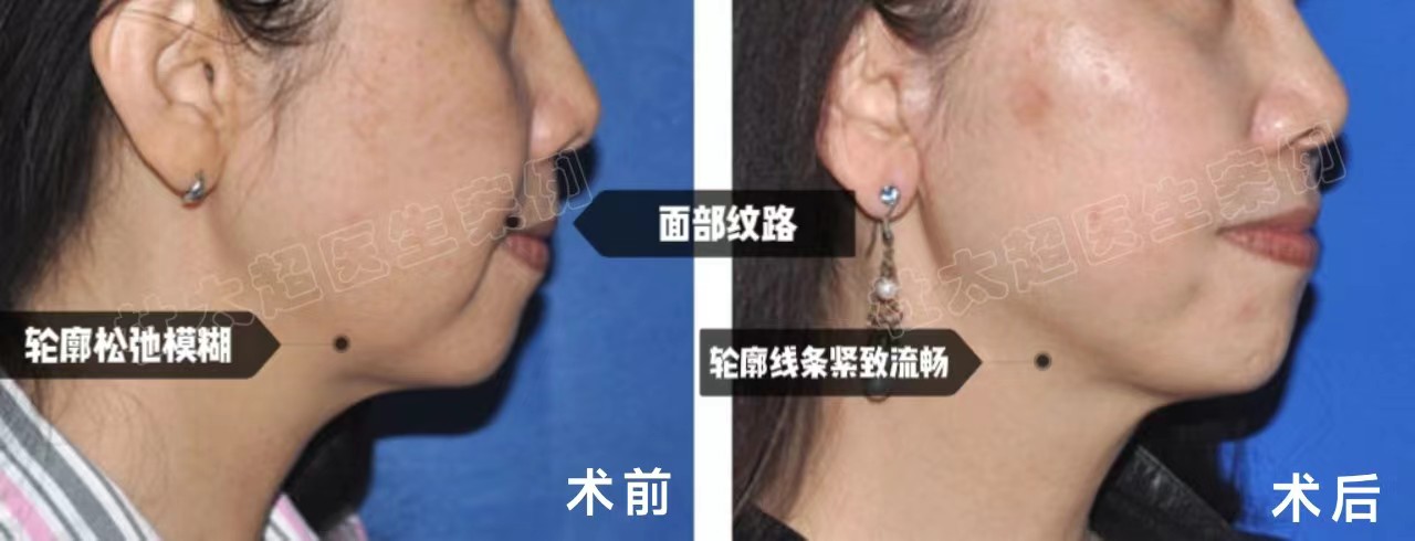 63岁做二次拉皮,活成令人羡慕的小女人,分享2点经验 63岁做二次拉皮,活成令人羡慕的小女人,分享2点经验