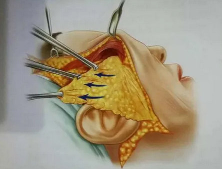 Caw小切口面部提升术和传统拉皮的差异性 Caw小切口面部提升术和传统拉皮的差异性