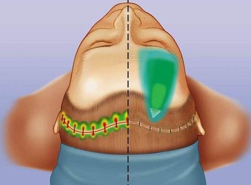 Caw小切口面部提升术和传统拉皮的差异性 Caw小切口面部提升术和传统拉皮的差异性