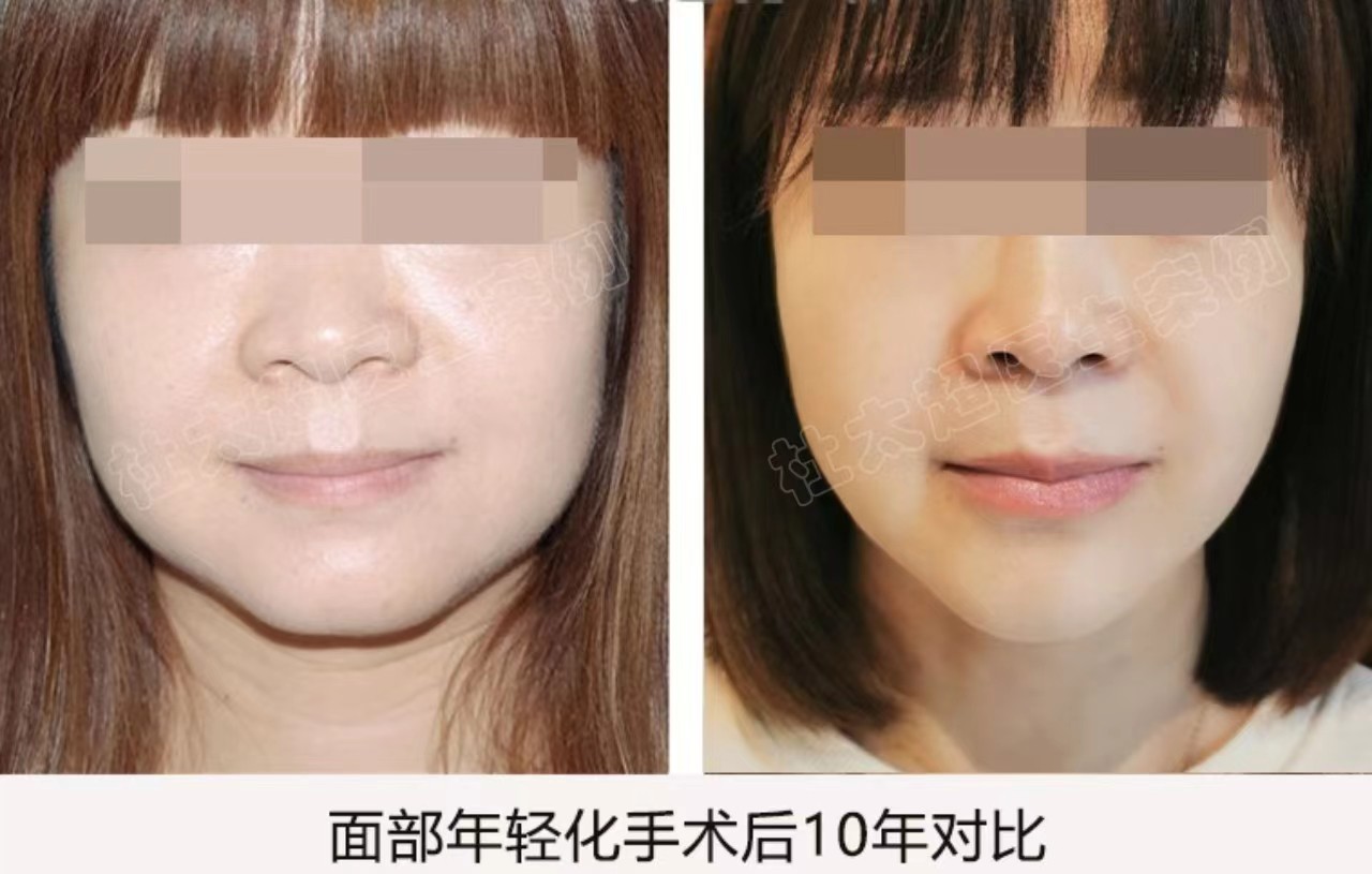 杜太超拉皮手术价格贵吗? 杜太超拉皮手术价格贵吗?