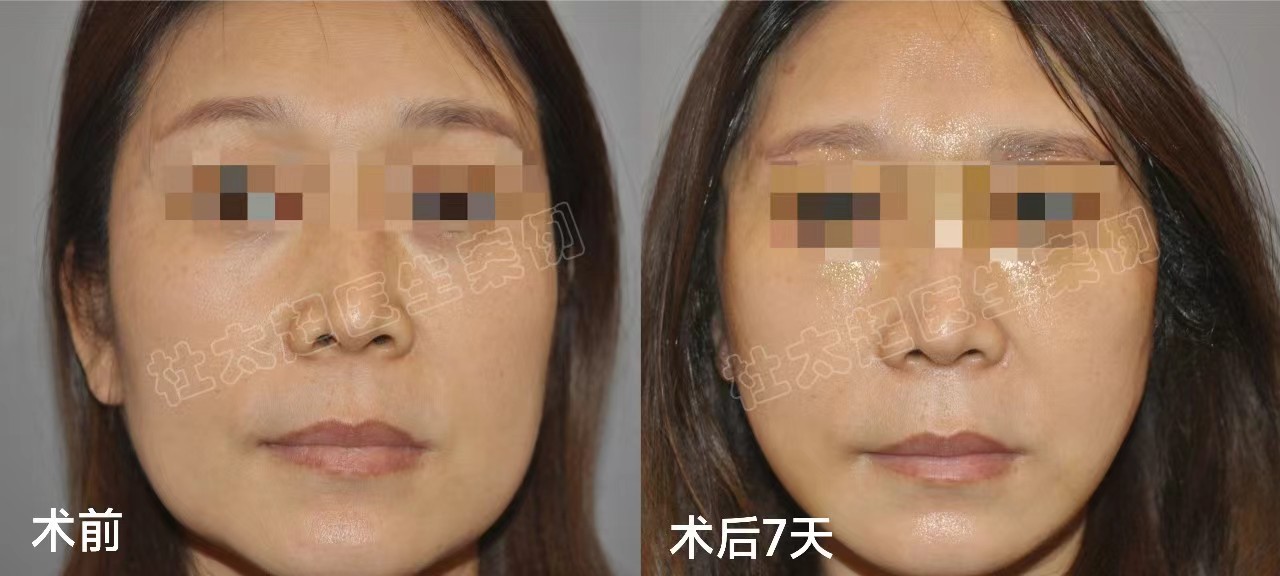 53岁狠心做了拉皮提升,才知道原来我对拉皮手术的误解太深了 53岁狠心做了拉皮提升,才知道原来我对拉皮手术的误解太深了