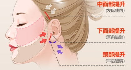 53岁狠心做了拉皮提升,才知道原来我对拉皮手术的误解太深了 53岁狠心做了拉皮提升,才知道原来我对拉皮手术的误解太深了