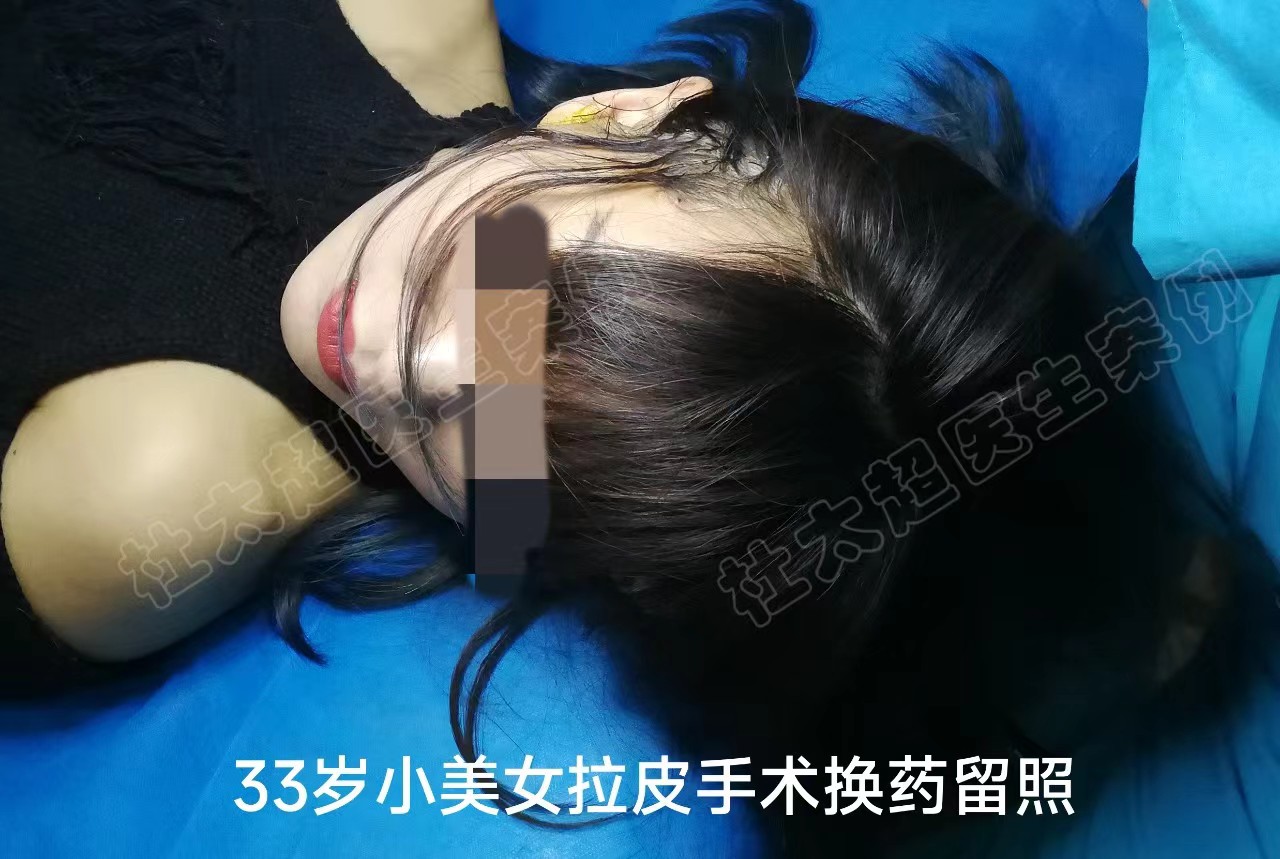 53岁狠心做了拉皮提升,才知道原来我对拉皮手术的误解太深了 53岁狠心做了拉皮提升,才知道原来我对拉皮手术的误解太深了