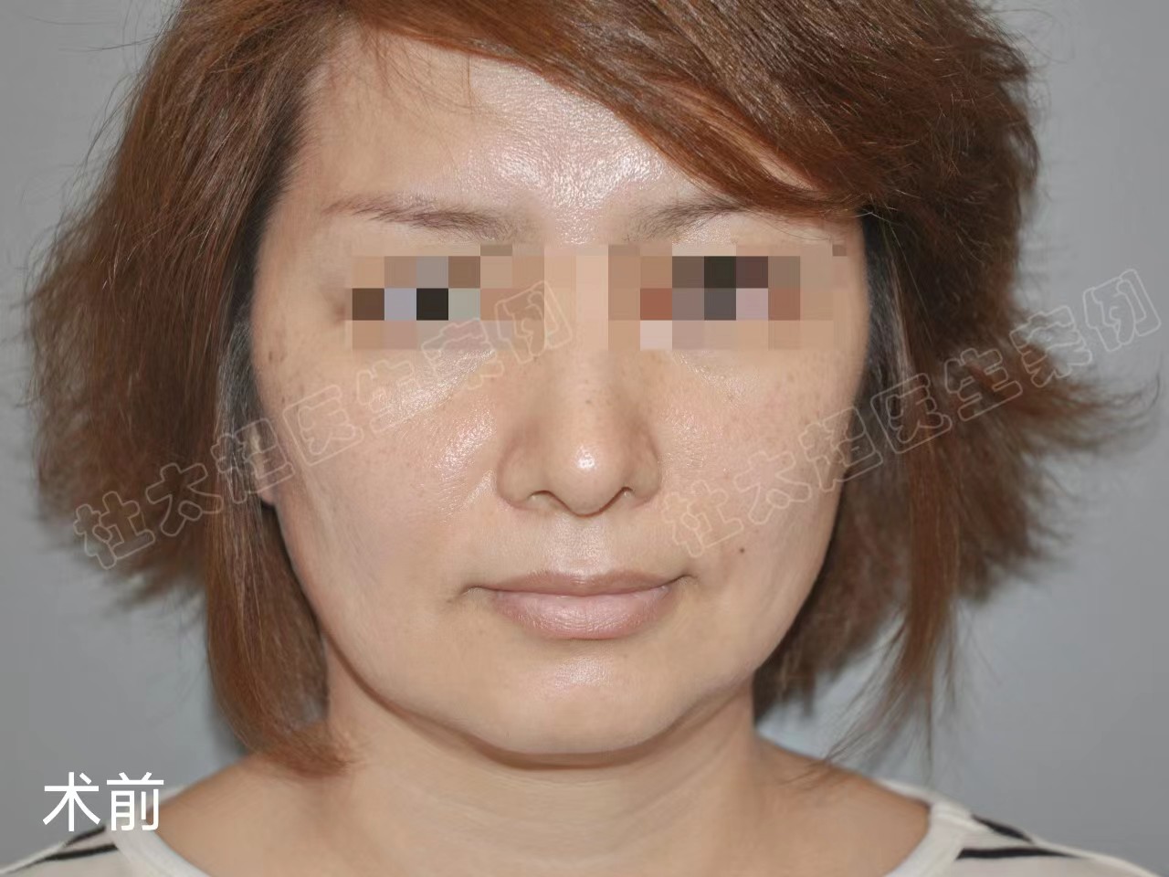 47岁定居国外多年，专程飞北京做拉皮手术，术后半年不敢认