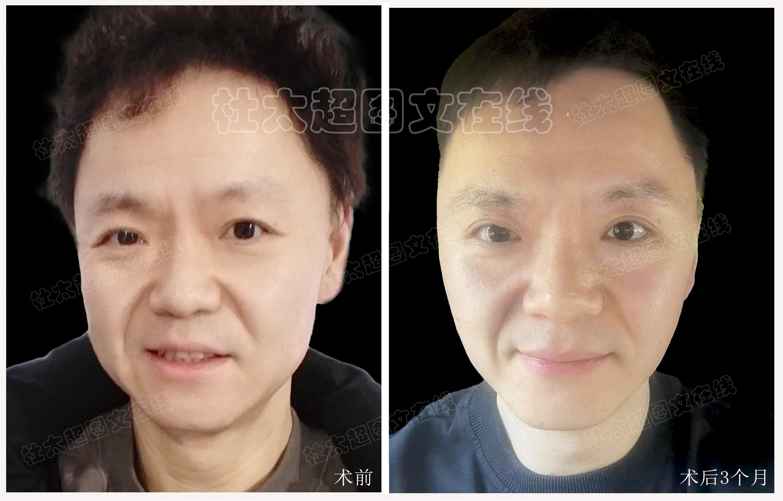 拉皮面部提升术后近期随访3个月