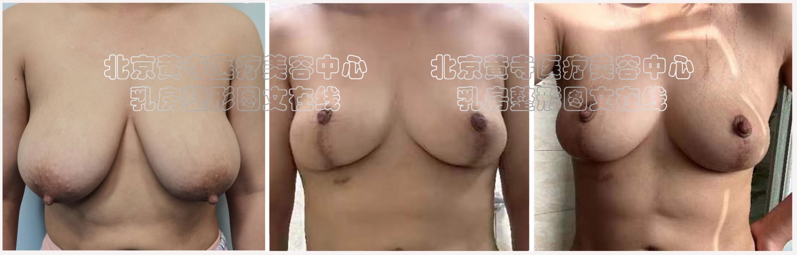 胸部整形2.jpg