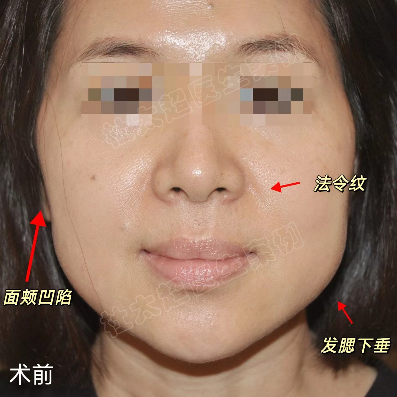 40岁肉肉脸女士做拉皮手术,效果如何? 40岁肉肉脸女士做拉皮手术,效果如何?