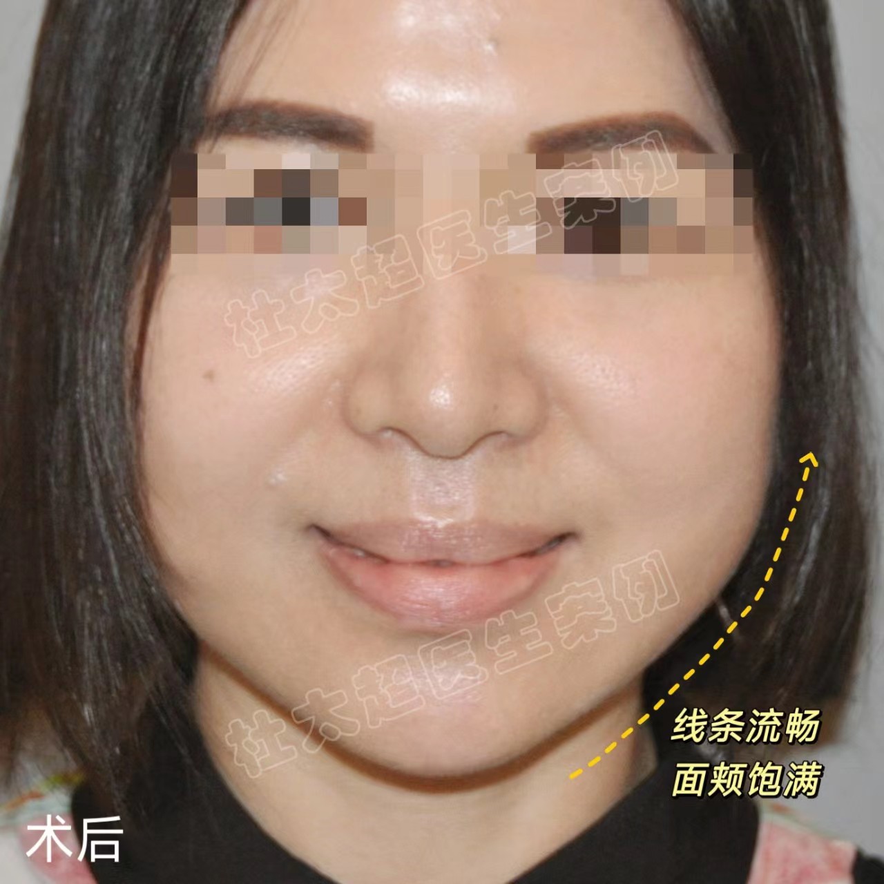 40岁肉肉脸女士做拉皮手术,效果如何? 40岁肉肉脸女士做拉皮手术,效果如何?