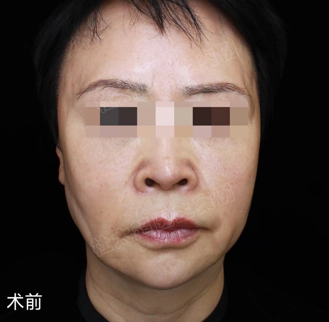 解决脸部皮肤松垂，最有效的方法是什么？求美者自述答案