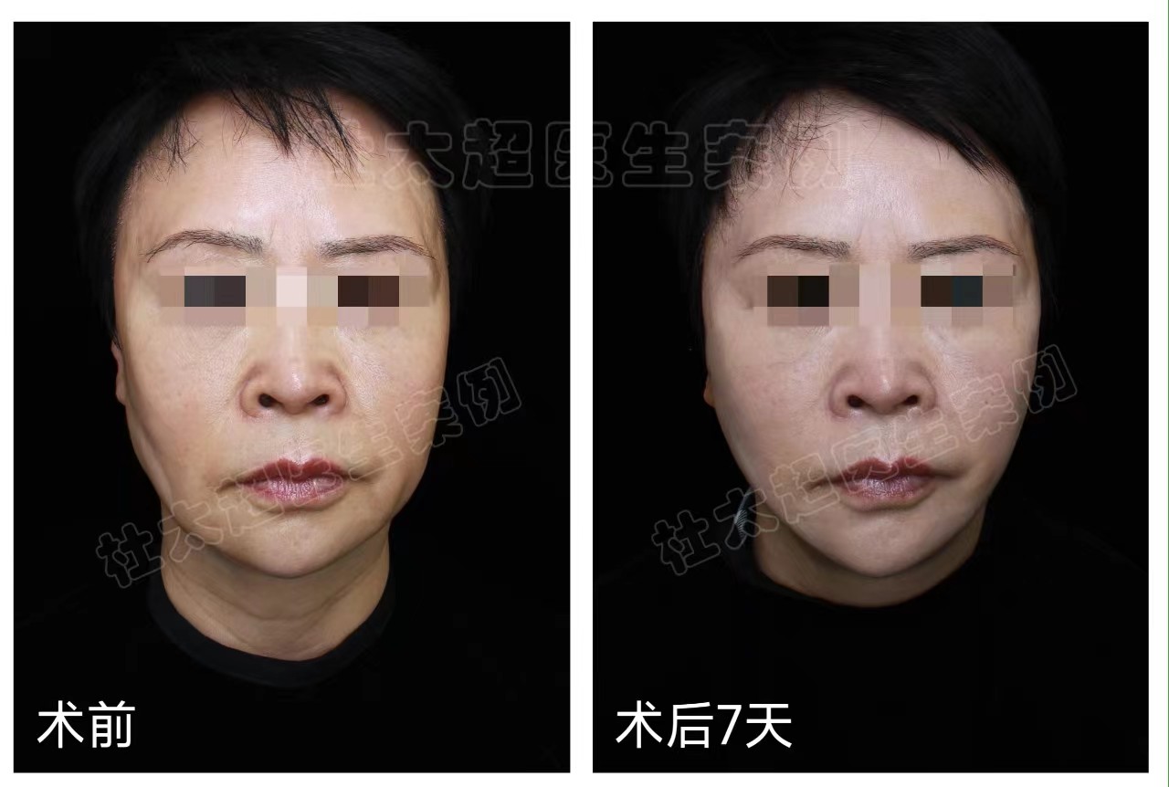 解决脸部皮肤松垂，最有效的方法是什么？求美者自述答案