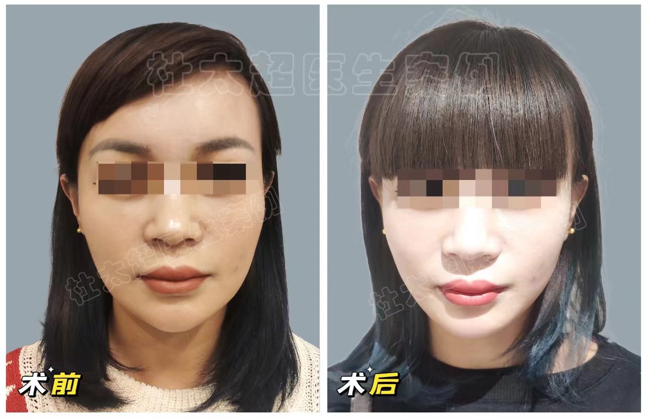 抗衰人士必看！拉皮手术的两种切口设计，各有千秋