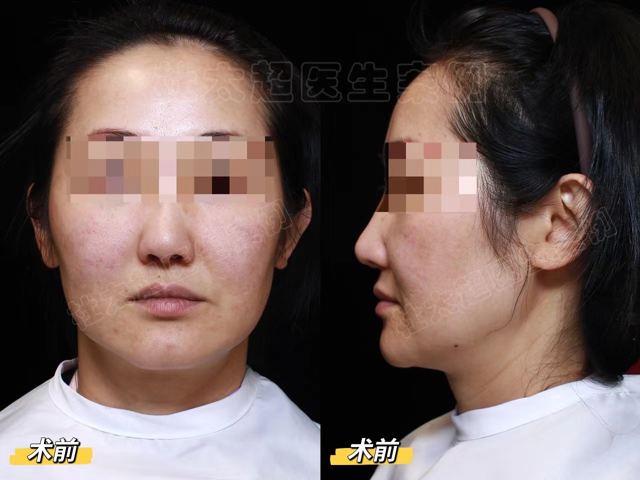 45岁求美者专程回国做拉皮手术，术后8天说说心里话