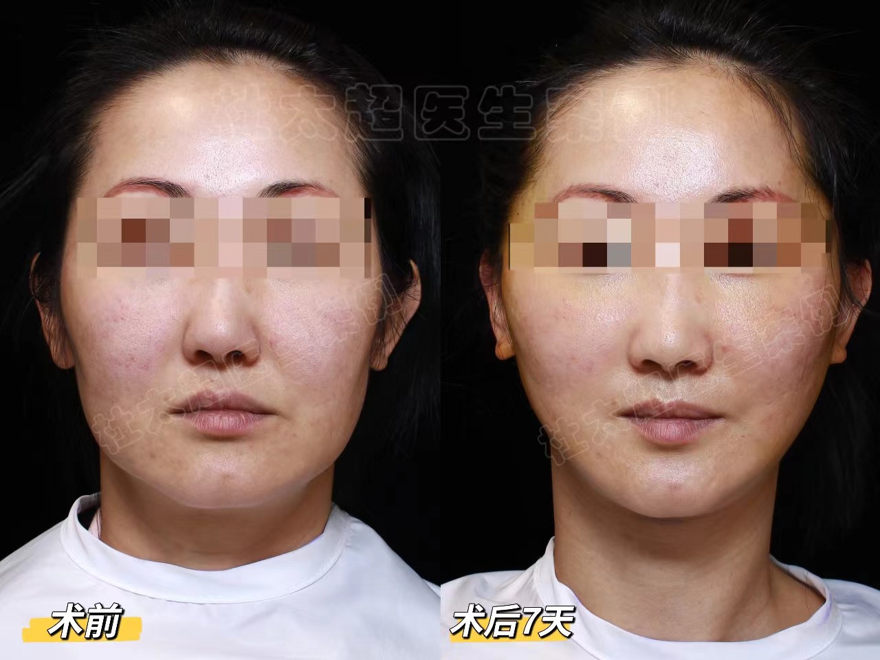 45岁求美者专程回国做拉皮手术，术后8天说说心里话