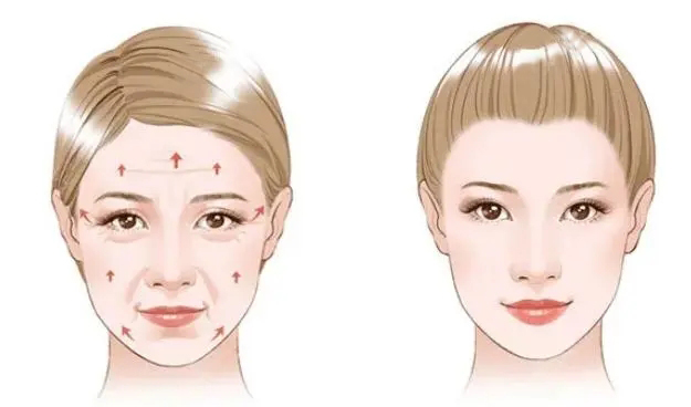 线雕和拉皮提升手术怎么选？