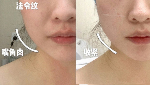 线雕和拉皮提升手术怎么选？