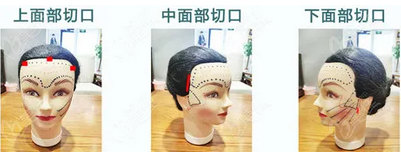 线雕和拉皮提升手术怎么选？