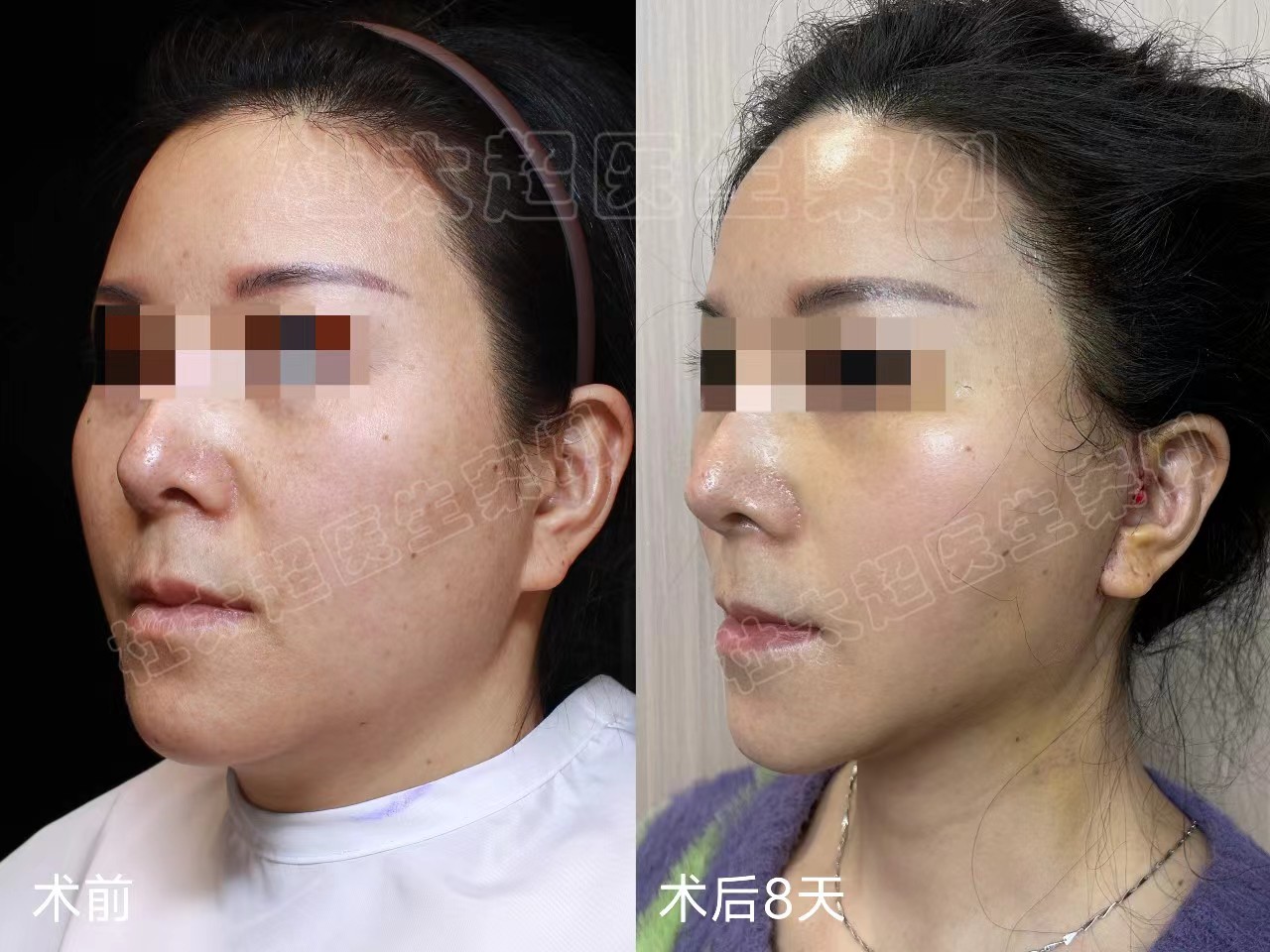 47岁苹果肌下垂，拉皮提升帮她扭转乾坤