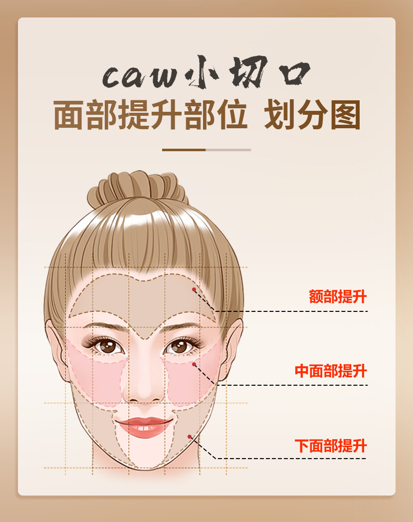 一篇文章，带你了解什么是caw小切口面部提升术？