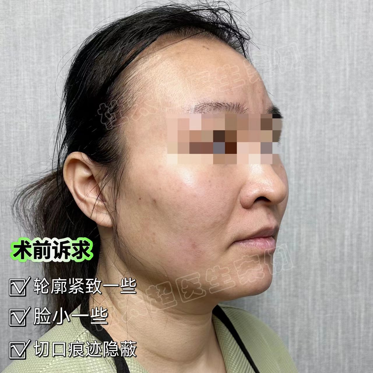 想年轻一些，但不想变化太大，医生为我这样设计