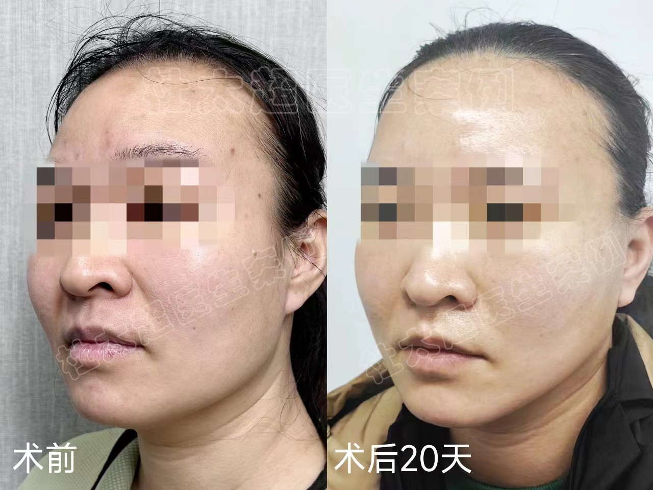 想年轻一些，但不想变化太大，医生为我这样设计