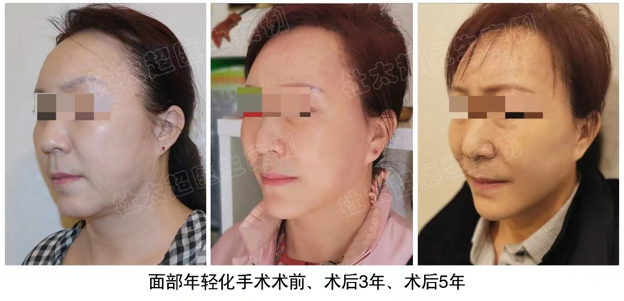 拉皮手术3年、5年后会变成什么样子？看看真人案例吧！