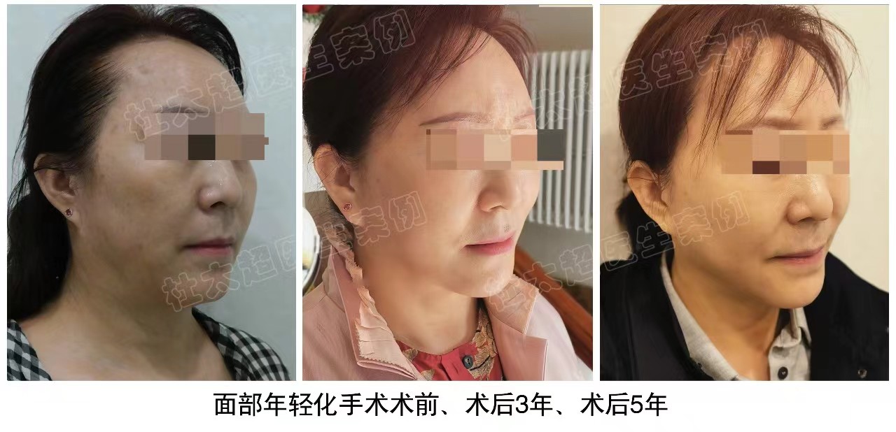 拉皮手术3年、5年后会变成什么样子？看看真人案例吧！