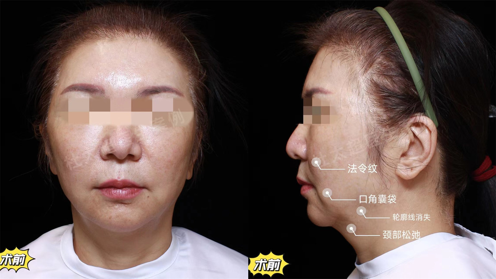 60岁专程到北京做拉皮手术，术后7天年龄成谜