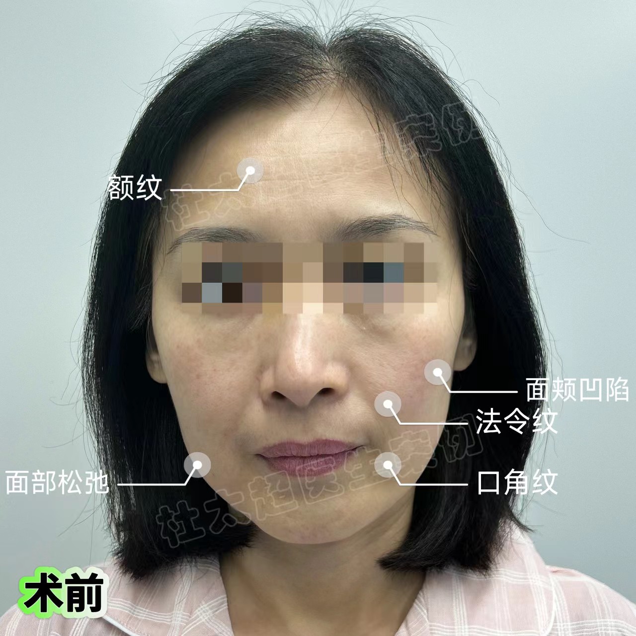 49岁医美小白，做拉皮手术抗衰，想要一步到位的效果！