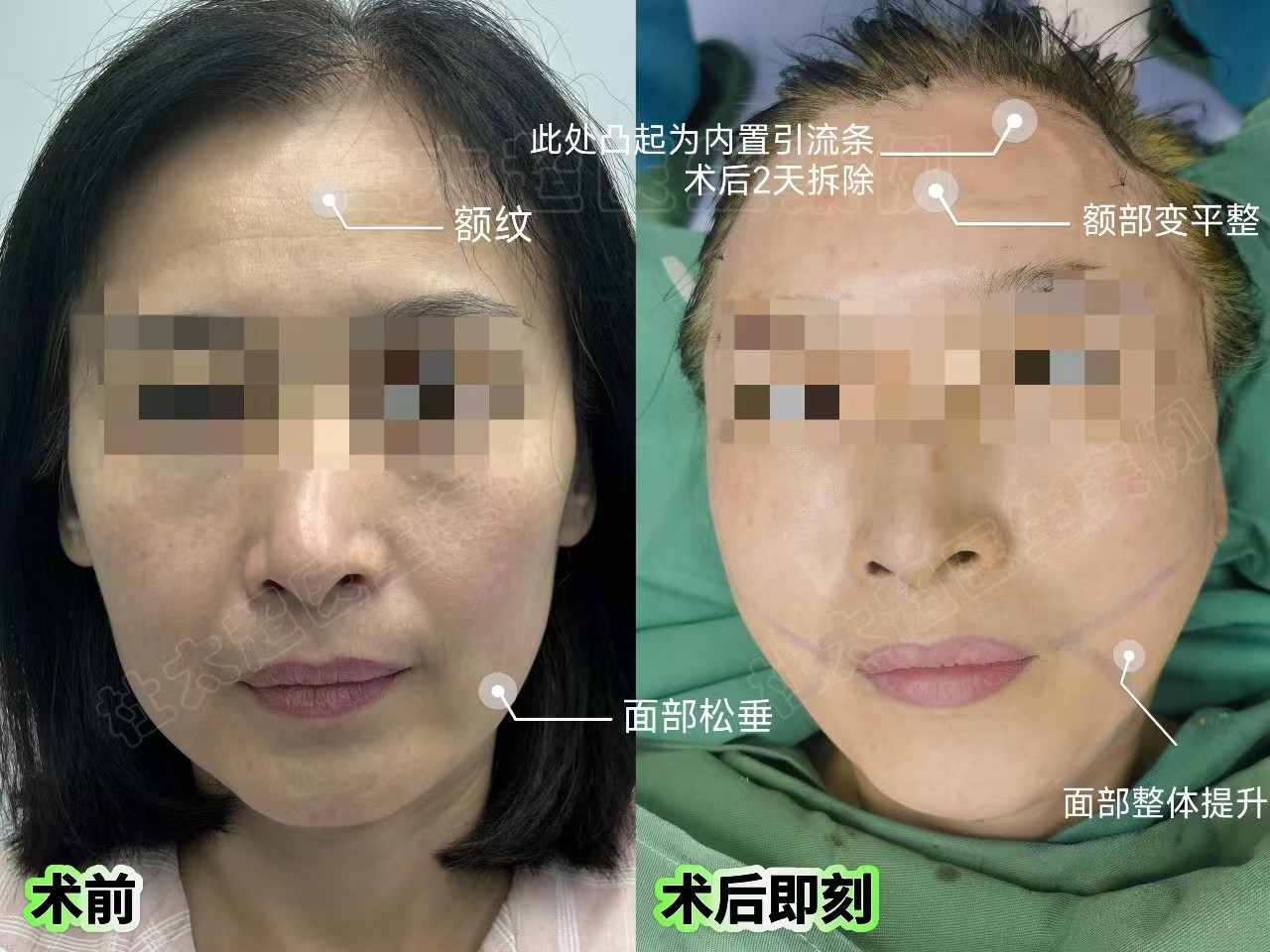49岁医美小白，做拉皮手术抗衰，想要一步到位的效果！