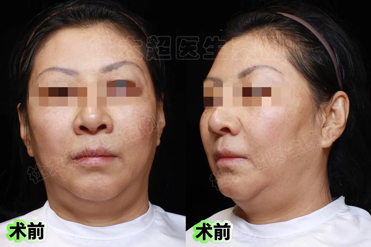 拉皮手术第7天、20天、30天实拍记录,脸大变样! 拉皮手术第7天、20天、30天实拍记录,脸大变样!