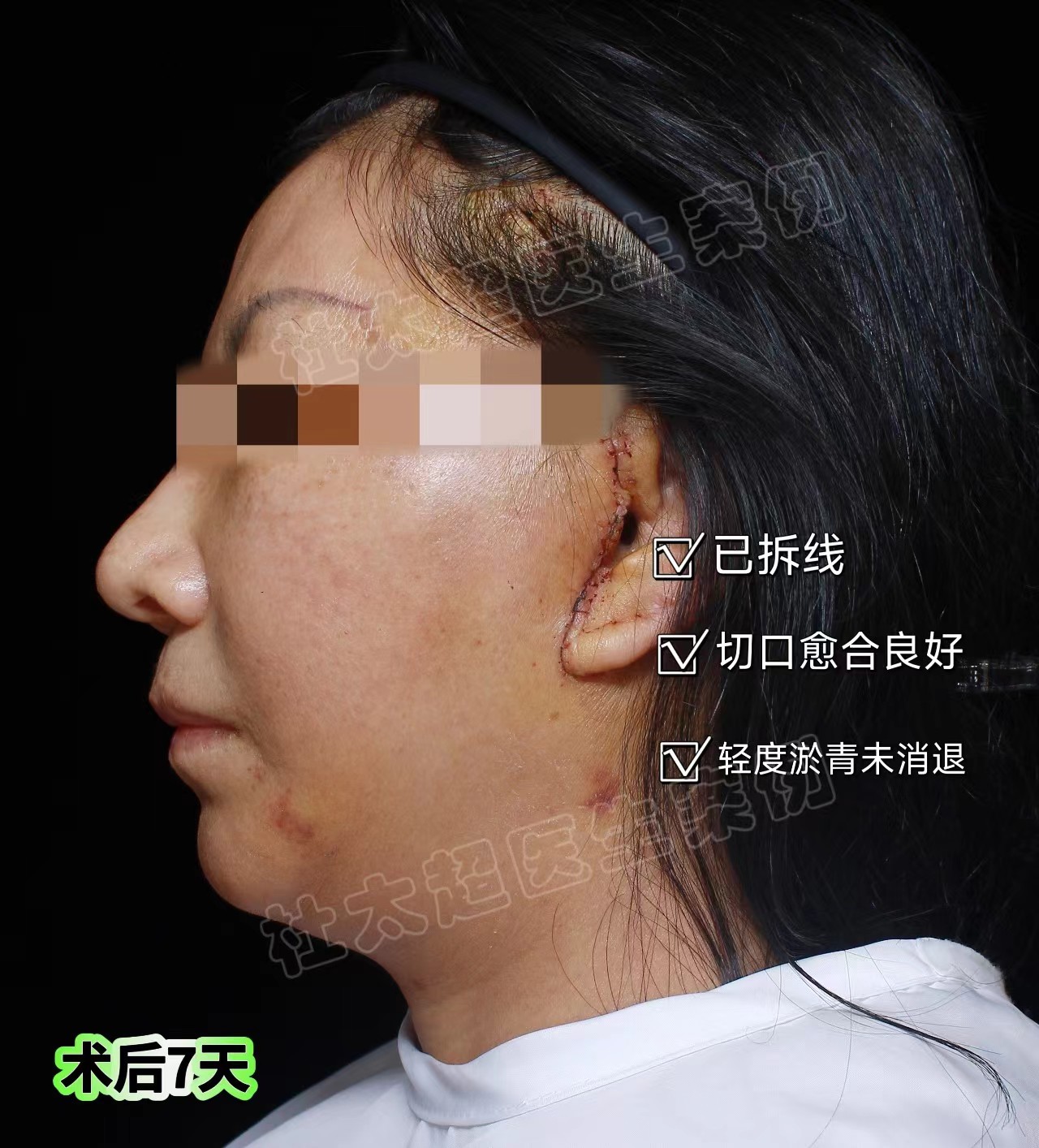 拉皮手术第7天、20天、30天实拍记录,脸大变样! 拉皮手术第7天、20天、30天实拍记录,脸大变样!