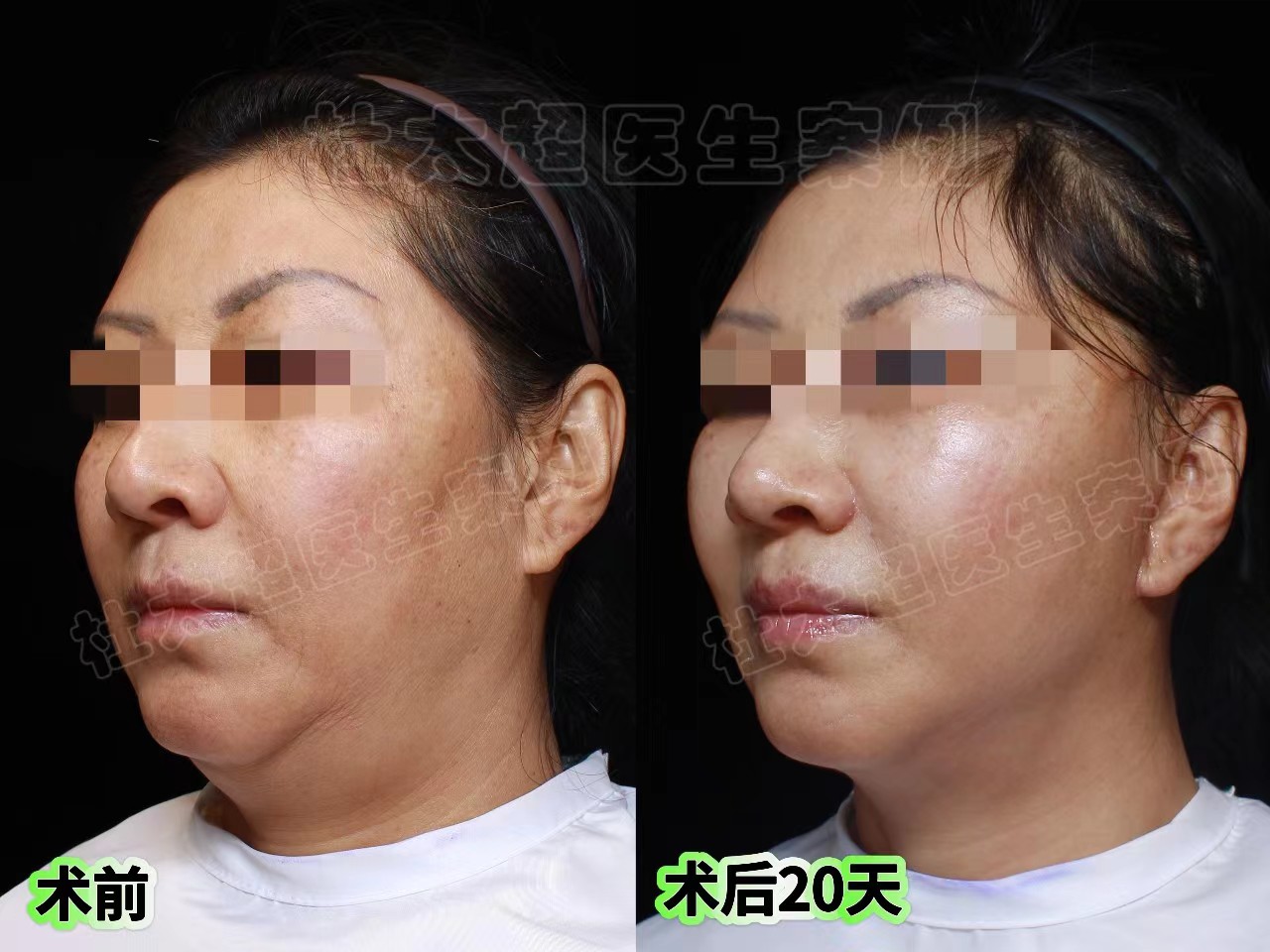 拉皮手术第7天、20天、30天实拍记录,脸大变样! 拉皮手术第7天、20天、30天实拍记录,脸大变样!