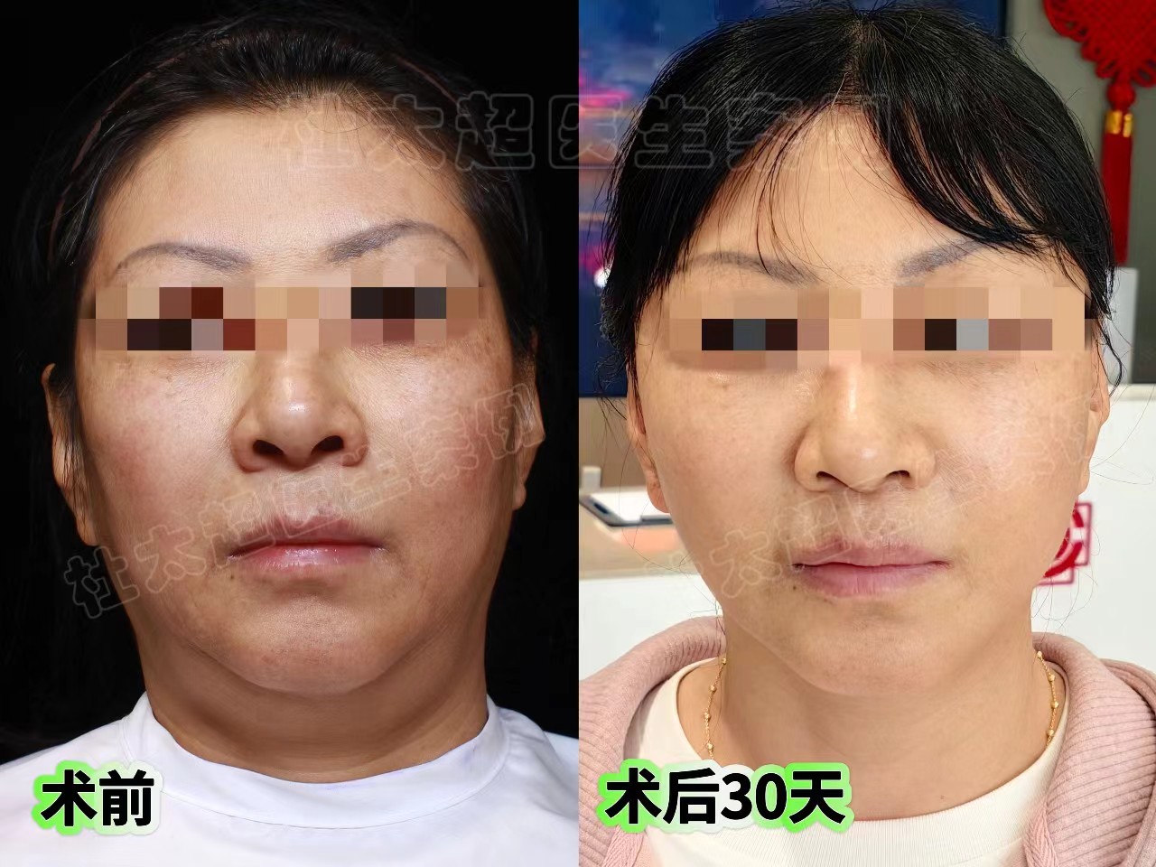 拉皮手术第7天、20天、30天实拍记录,脸大变样! 拉皮手术第7天、20天、30天实拍记录,脸大变样!