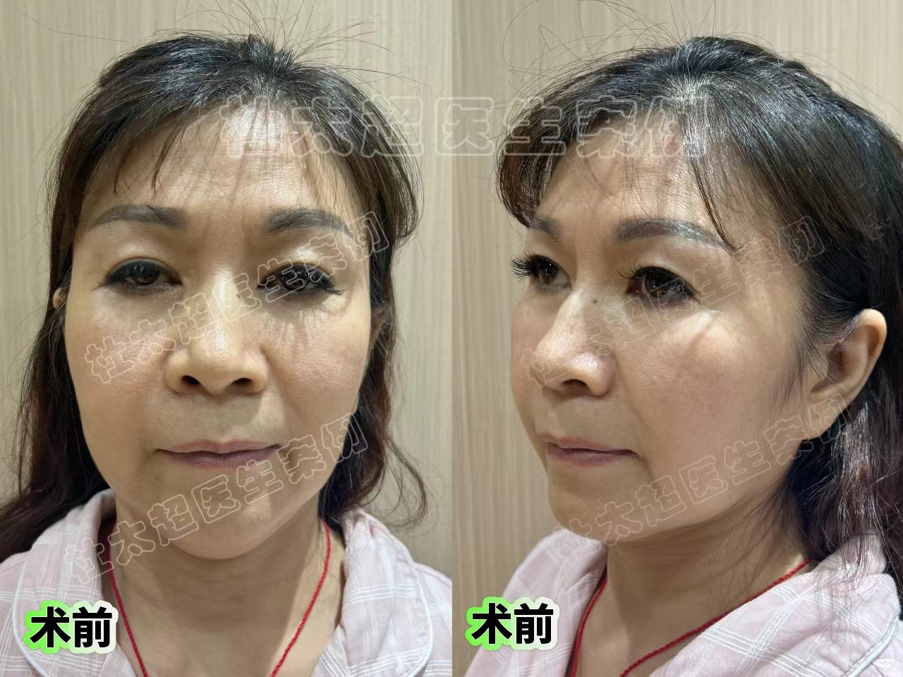 58岁跨越大半个中国，到北京挑战拉皮，术后2个月找回青春