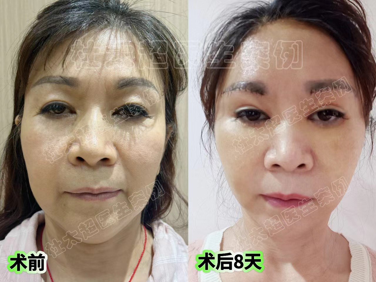 58岁跨越大半个中国，到北京挑战拉皮，术后2个月找回青春