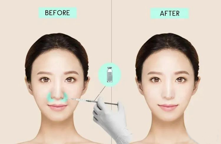 法令纹填充玻尿酸多久恢复自然？