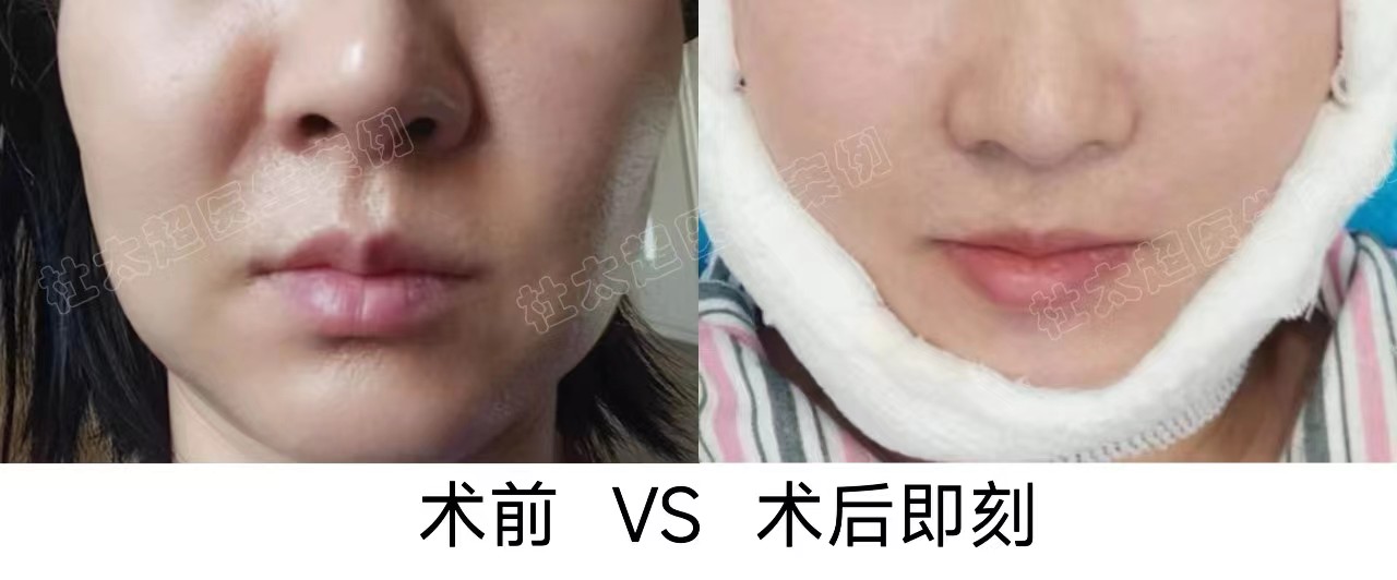 47岁不满法令纹深邃，通过拉皮手术找回自信