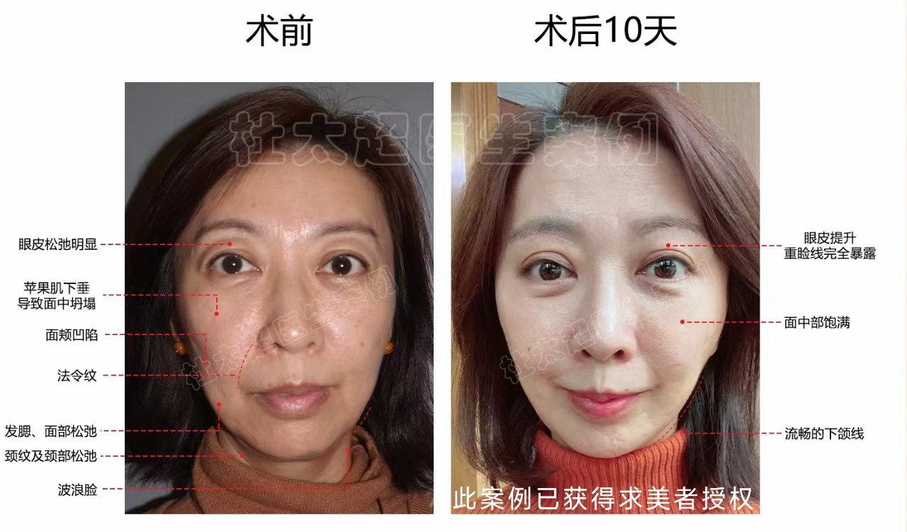 Caw小切口面部提升与传统拉皮、线雕、注射除皱、光电除皱的区别