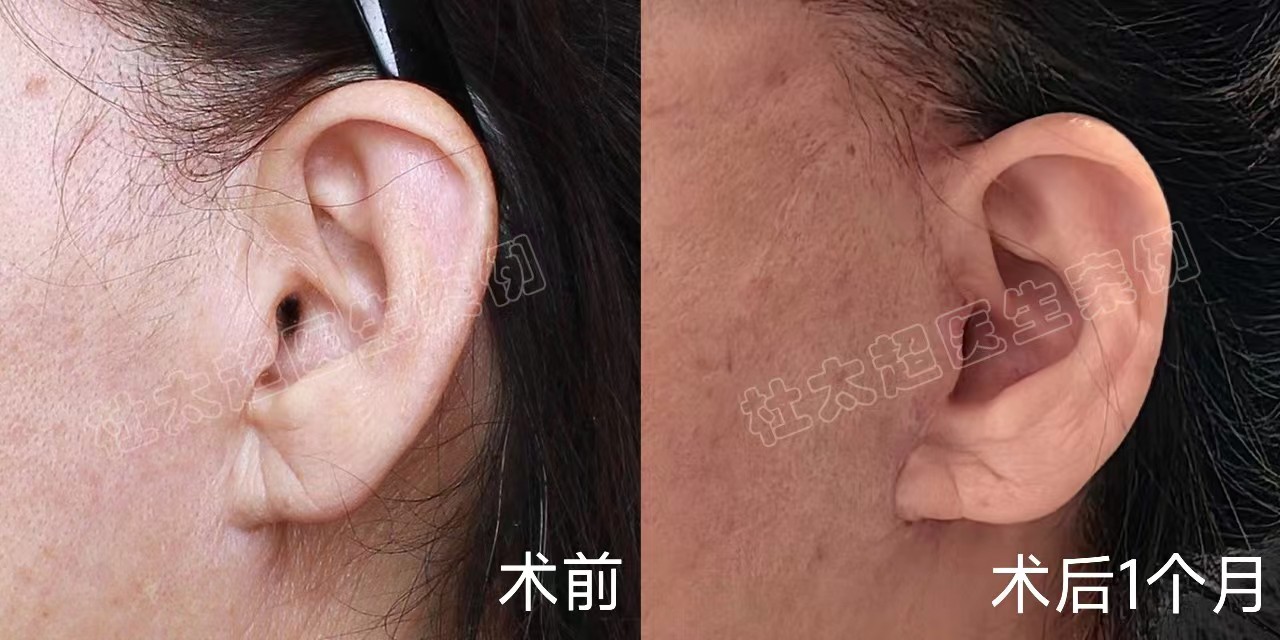 63岁面部松垮下垂,多次做项目改善,都不及拉皮效果确切 63岁面部松垮下垂,多次做项目改善,都不及拉皮效果确切