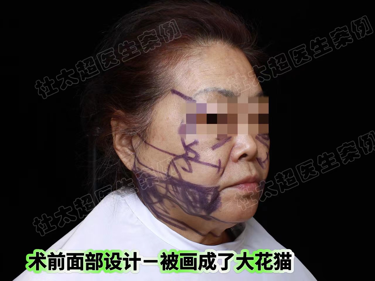 真人案例展示，拉皮确实比线雕强一万倍