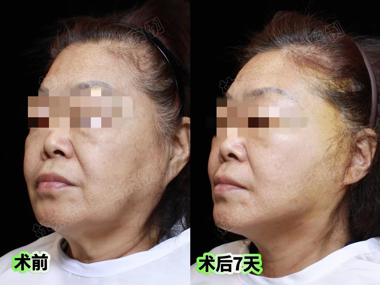 真人案例展示，拉皮确实比线雕强一万倍