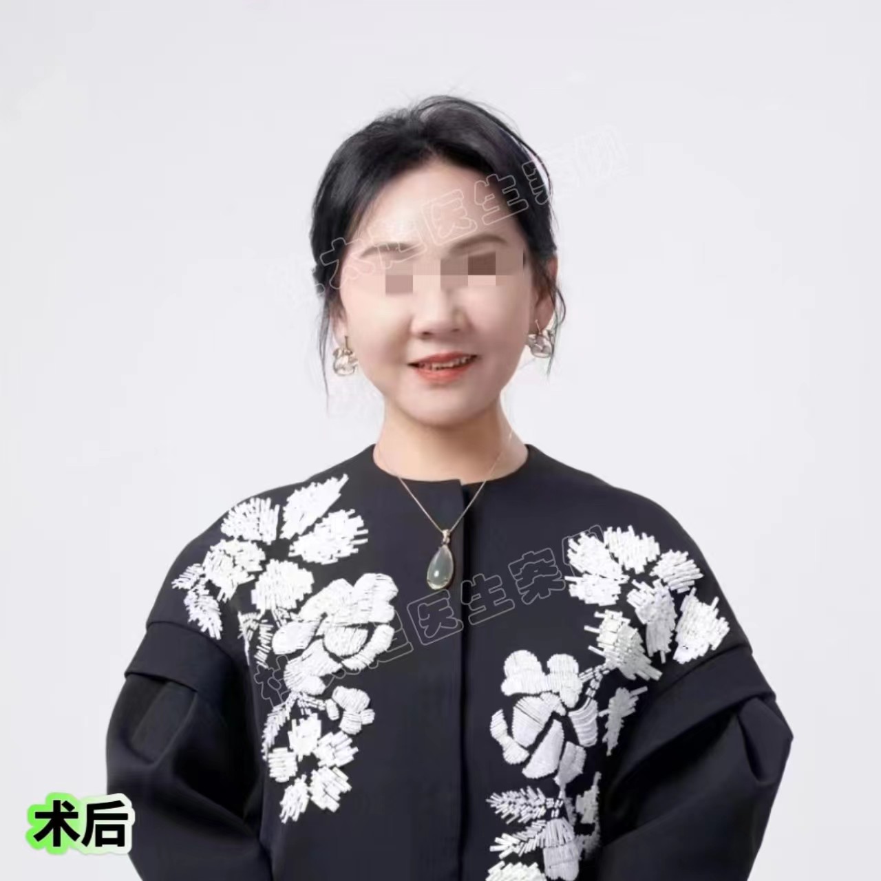 安享晚年的年纪做了拉皮手术,结果爆改成功! 安享晚年的年纪做了拉皮手术,结果爆改成功!