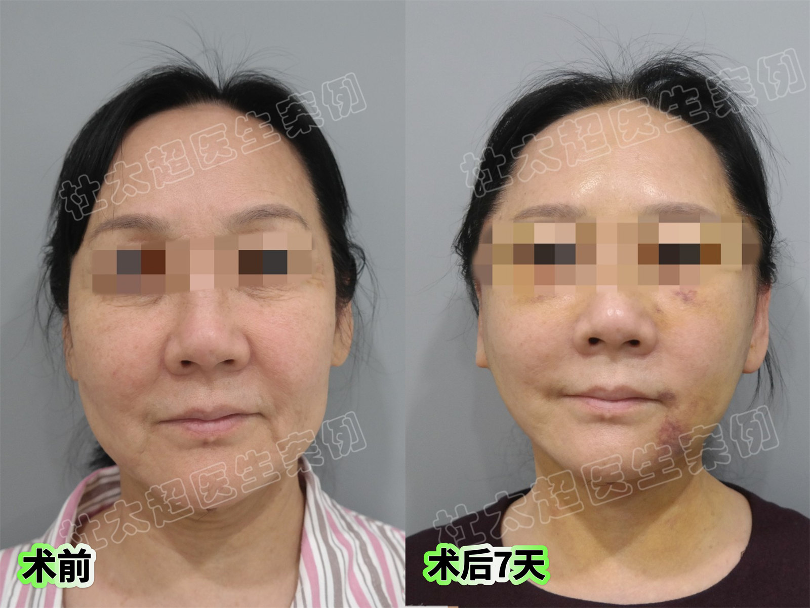 安享晚年的年纪做了拉皮手术,结果爆改成功! 安享晚年的年纪做了拉皮手术,结果爆改成功!