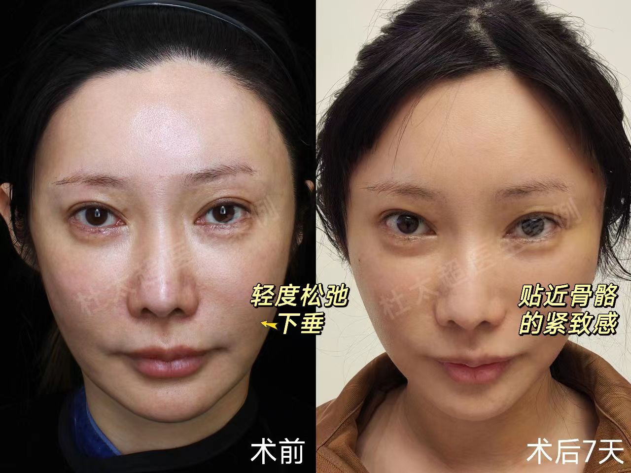 真人案例分享拉皮蜕变过程，揭秘做拉皮多久能恢复？